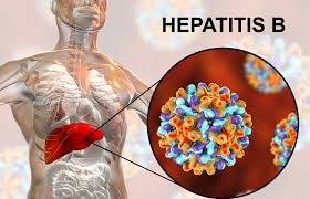 Indwara z’uzumwijima zizwi nka HEPATITIS ziri muzica abantu besnhi ku Isi